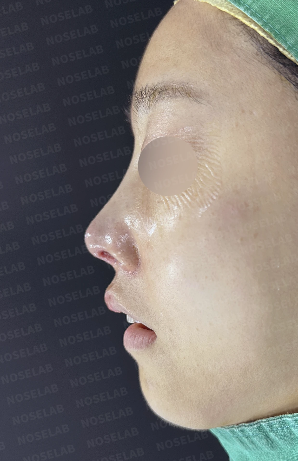코끝 피부가 얇아져 연골이 비치는 이유, 피부 보강은 어떻게 하나 — 수술 전 / 수술 직후 0일 직후 사진은 부기가 있는 상태로 최종 결과와 다를 수 있습니다.