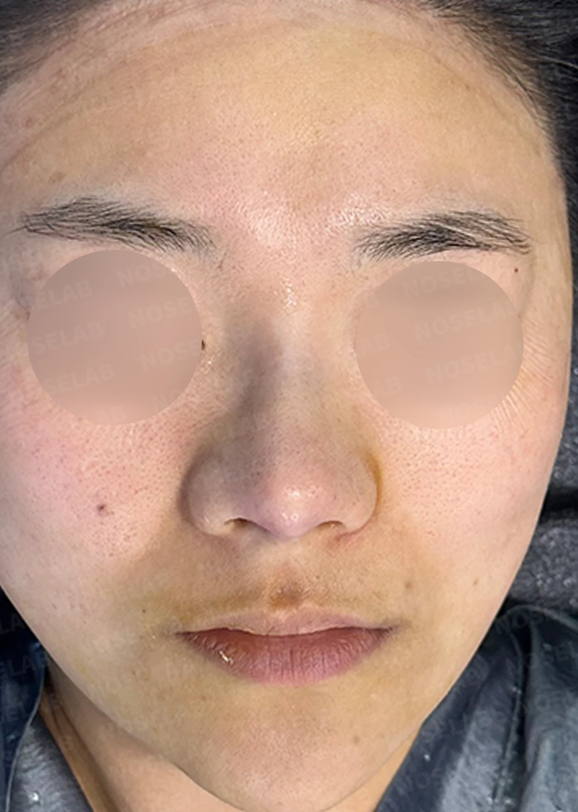 복코 수술은 어떻게 하나요? — 수술 전 / 수술 직후 0일 직후 사진은 부기가 있는 상태로 최종 결과와 다를 수 있습니다.