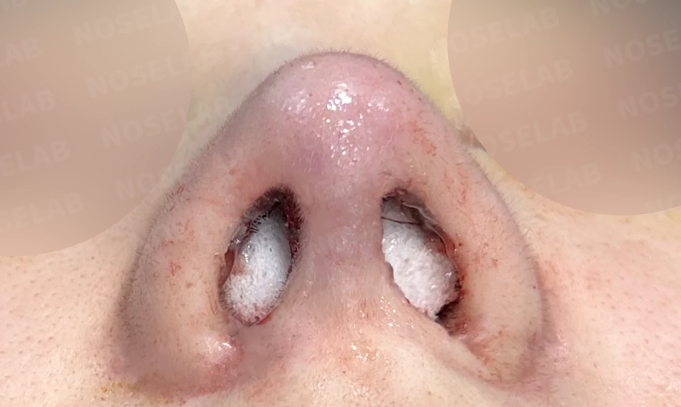 코가 뭉툭하고 퍼져 보이는 이유, 비순각과 비주는 어떻게 교정하나 — 수술 직후 0일 비공 사진 직후 사진은 부기가 있는 상태로 최종 결과와 다를 수 있습니다.