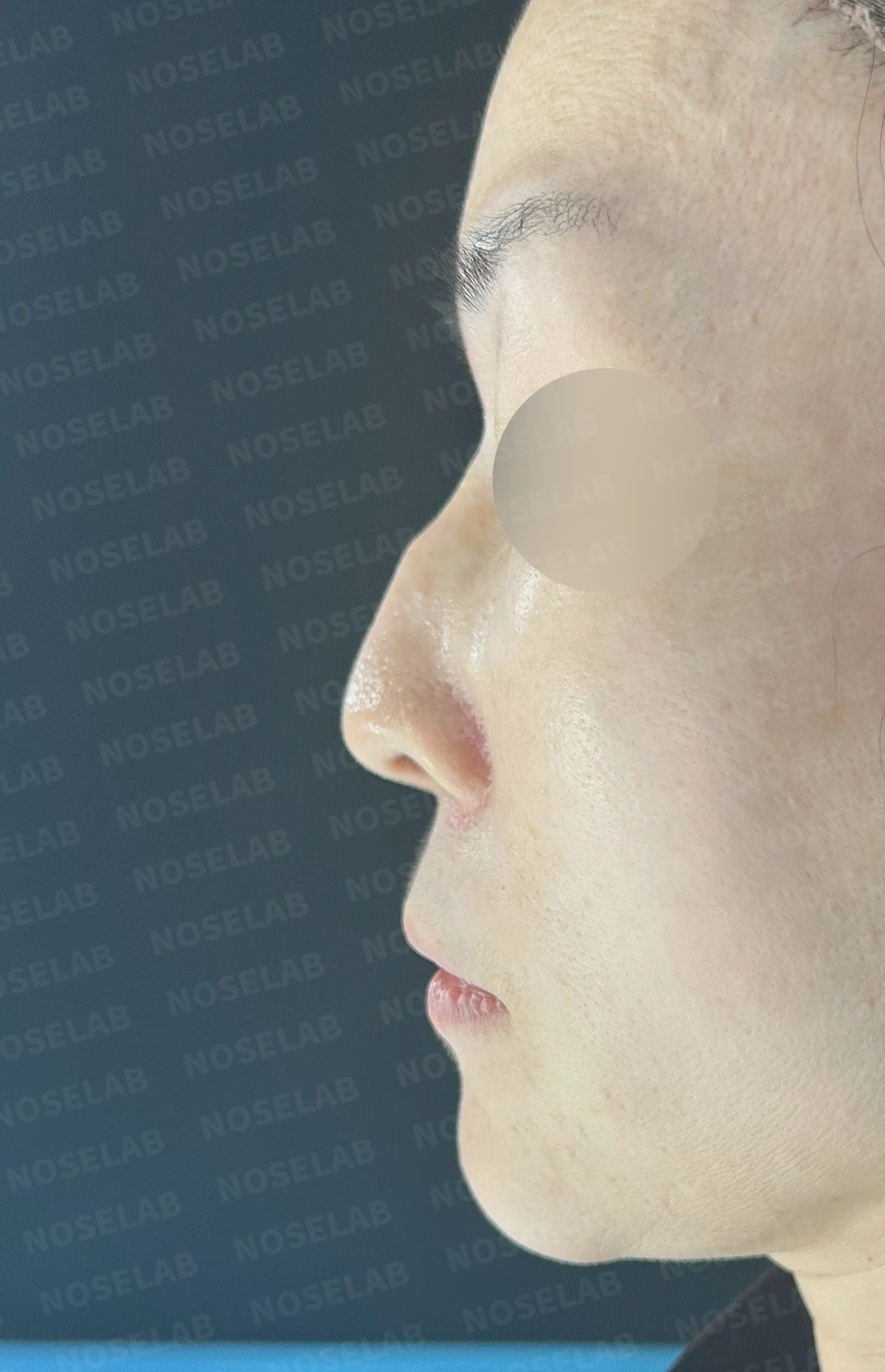 오래된 실리콘 피막이 석회화되면 왜 매부리와 휜 코가 생기나 — 본문 사진 9