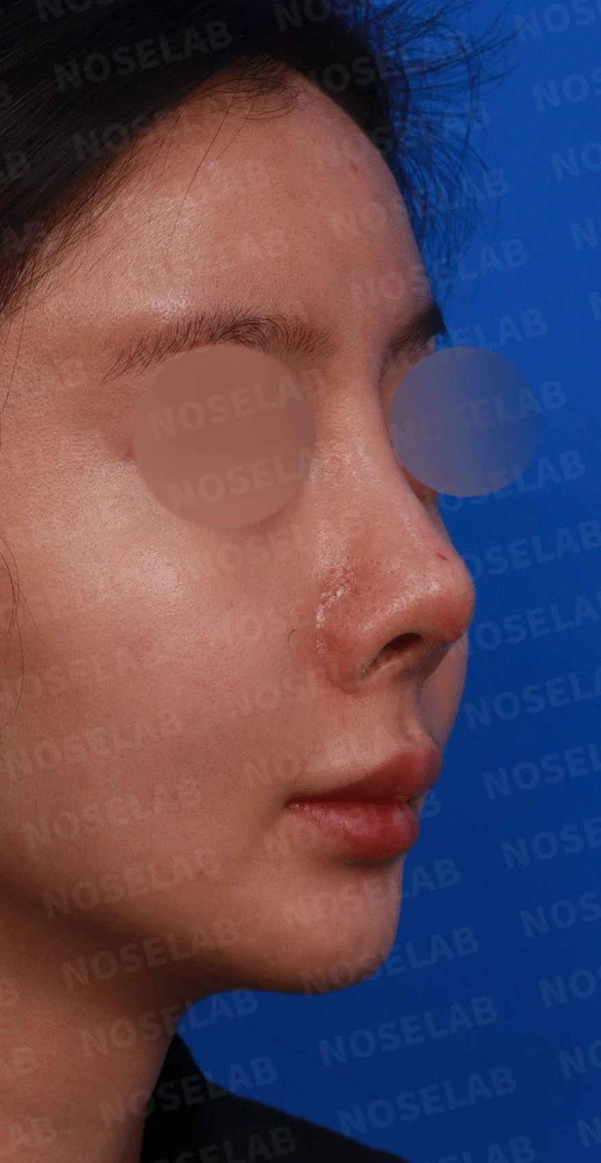 실리콘 보형물이 코끝 피부를 뚫고 나오려 할 때, 왜 생기고 어떻게 재건하나 — 디자인 상담 비공, 우측 측면, 비스듬한 측면 사진