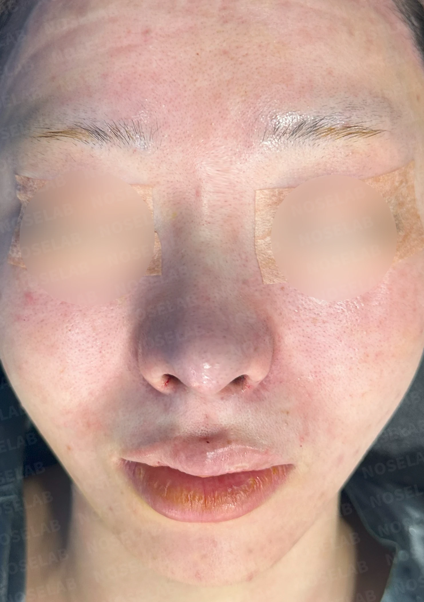 퍼진코, 복코 교정으로 균형 잡힌 이미지 완성 — 전(좌) 직후(우)