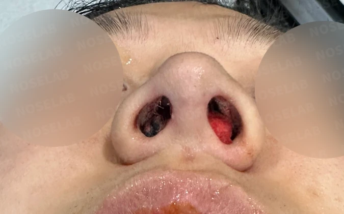 코막힘과 복코를 함께 살펴보는 교정 방법 — 수술 전 / 수술 직후 0일 직후 사진은 부기가 있는 상태로 최종 결과와 다를 수 있습니다.