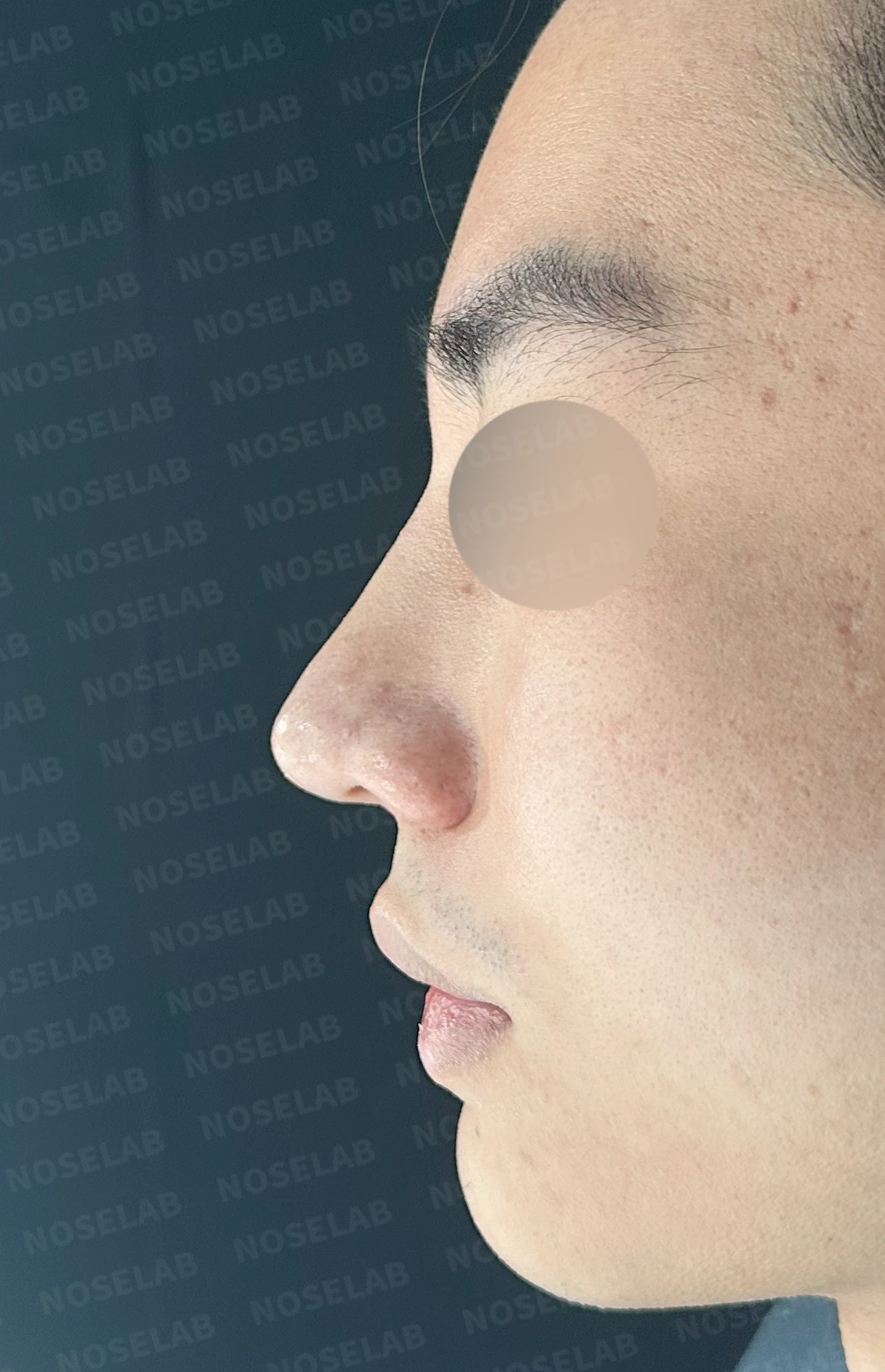 코뼈 골절에 미용 수술을 함께 할 수 있는 경우와 단계로 나누는 방법 — 수술 전 / 수술 직후 0일 직후 사진은 부기가 있는 상태로 최종 결과와 다를 수 있습니다.