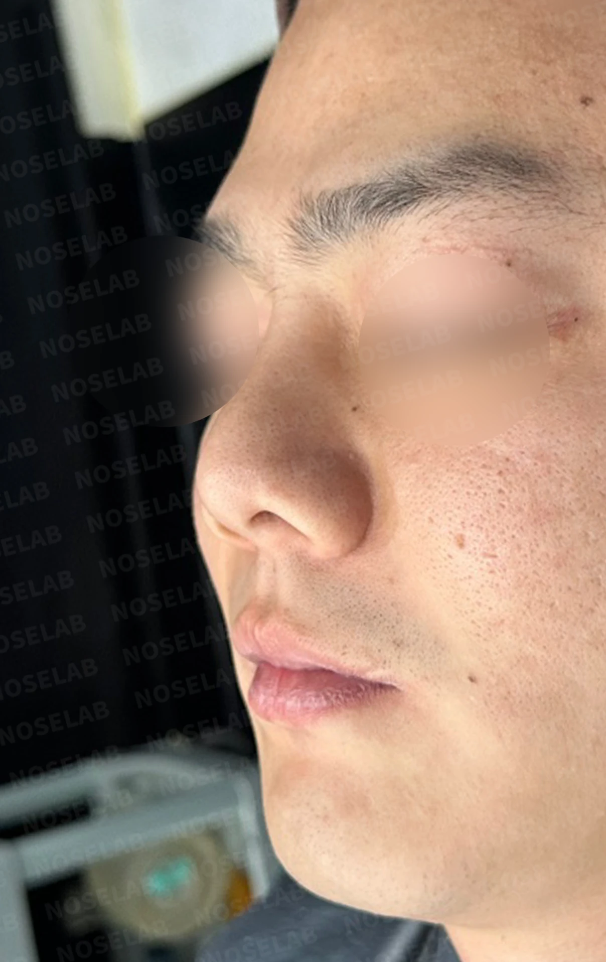 콧구멍 비대칭과 들린 코가 함께 생기는 이유, 늑연골 재건은 어떻게 하나 — 수술 전 / 수술 직후 0일 직후 사진은 부기가 있는 상태로 최종 결과와 다를 수 있습니다.