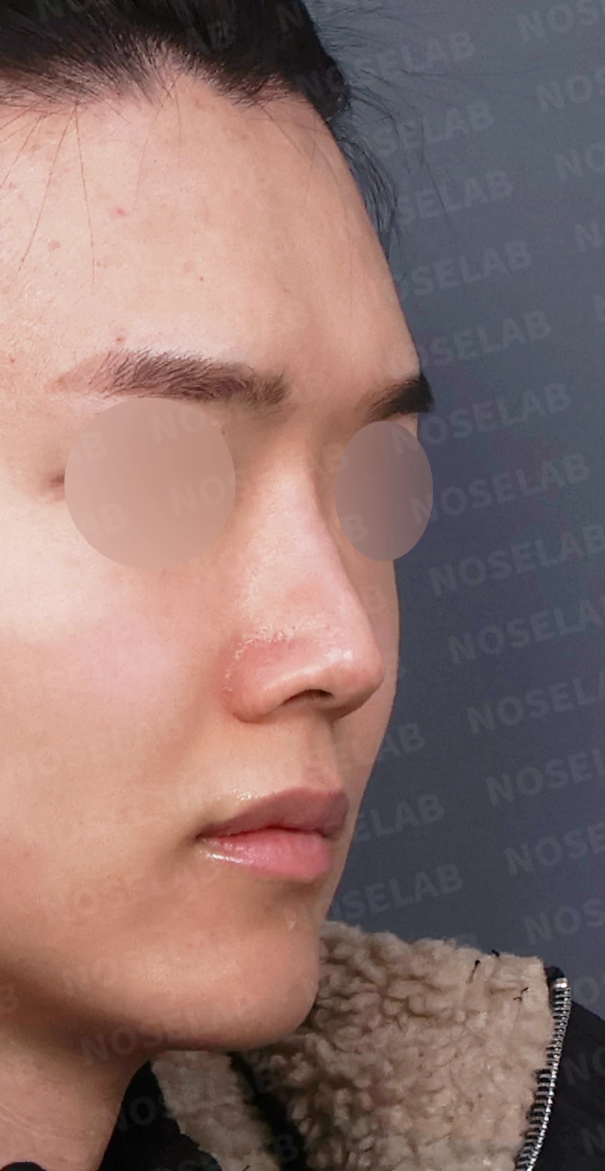 코가 낮아 보이는 이유와 자가 늑연골로 높이를 만드는 방법 — 디자인 상담 우측 측면, 비스듬한 측면, 비공 사진입니다.