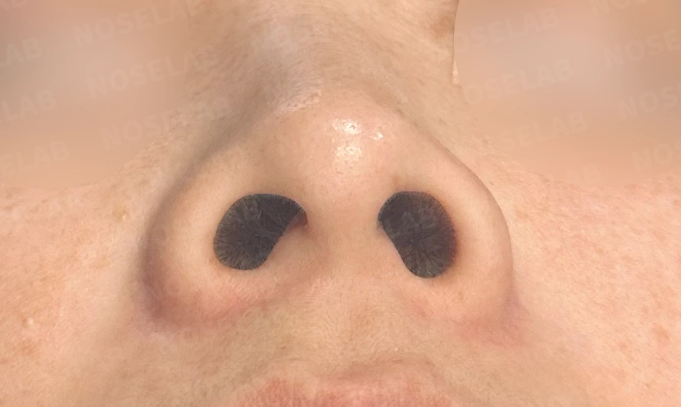 첫 코성형에서 코끝 구조와 콧구멍 노출은 어떻게 다루나 — 수술 전 / 수술 직후 0일 직후 사진은 부기가 있는 상태로 최종 결과와 다를 수 있습니다.