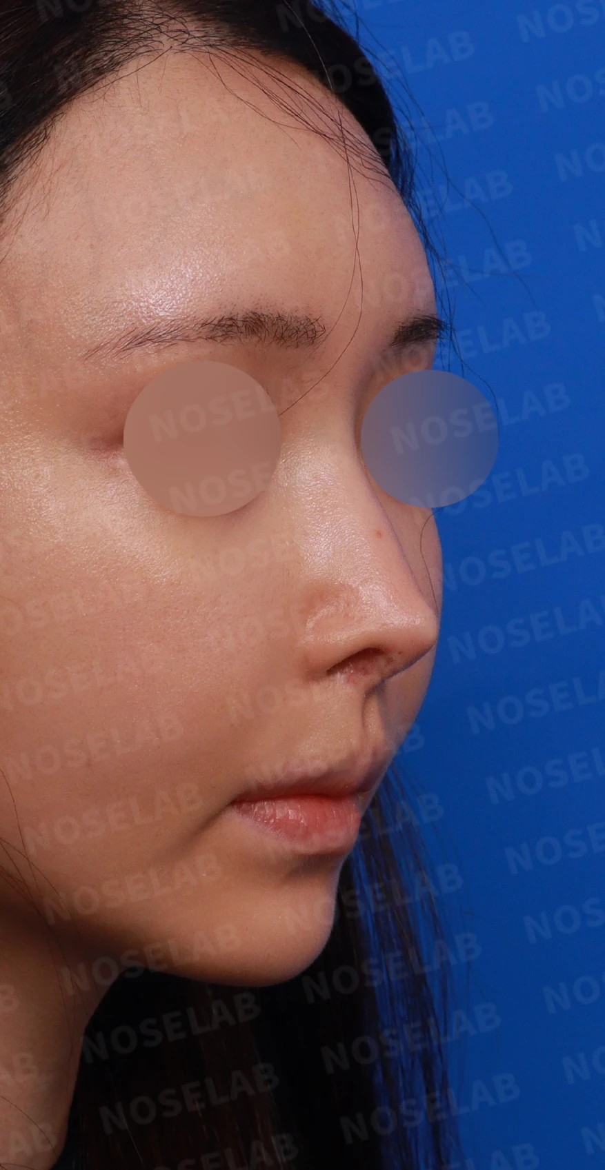 뾰족한 코끝과 연골 비침의 교정 방법 — 디자인 상담 우측 측면, 비스듬한 측면, 비공 사진입니다.