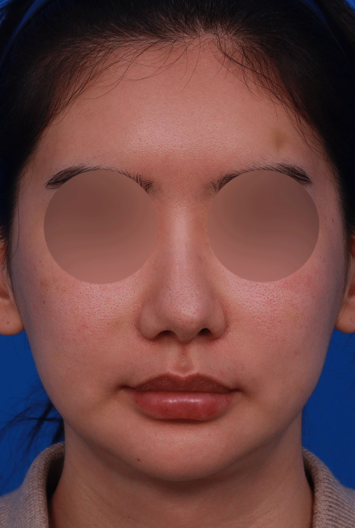 코가 과하게 높아져 부자연스러워 보이고 휘는 이유, 재건은 어떻게 하나 — 디자인 상담 정면 , 좌측 비스듬한 측면 , 측면 사진입니다.