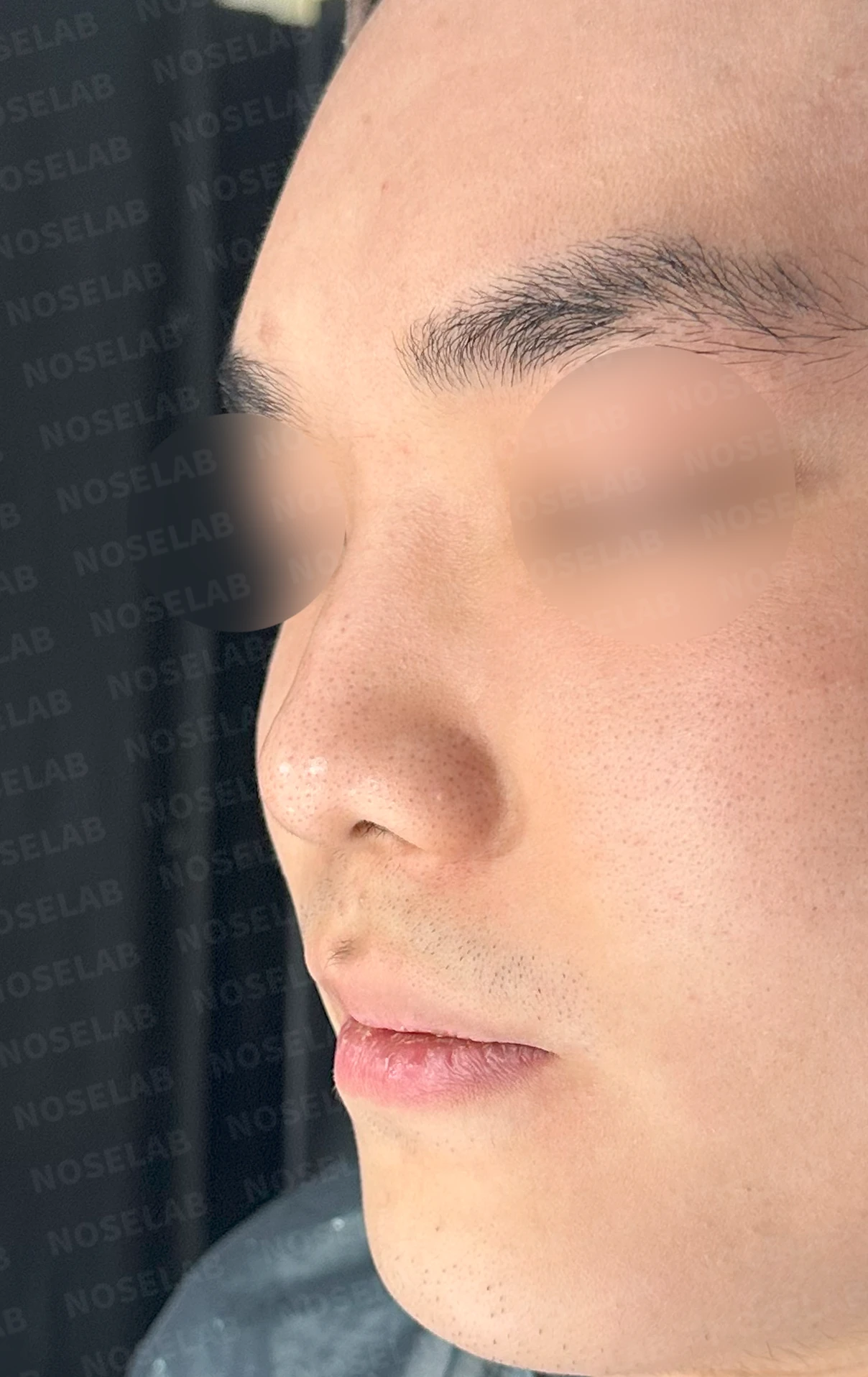 코 실 시술과 지방이식 후 라인이 잡히지 않는 이유, 제거와 늑연골 재건은 어떻게 하나 — 수술 전 / 수술 직후 0일 직후 사진은 부기가 있는 상태로 최종 결과와 다를 수 있습니다.