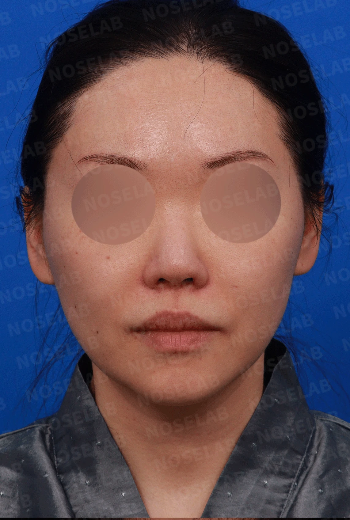 인공진피가 흡수되며 콧대가 낮아지고 퍼지는 이유 — 디자인 상담 정면, 좌측 측면, 비스듬한 측면 사진
