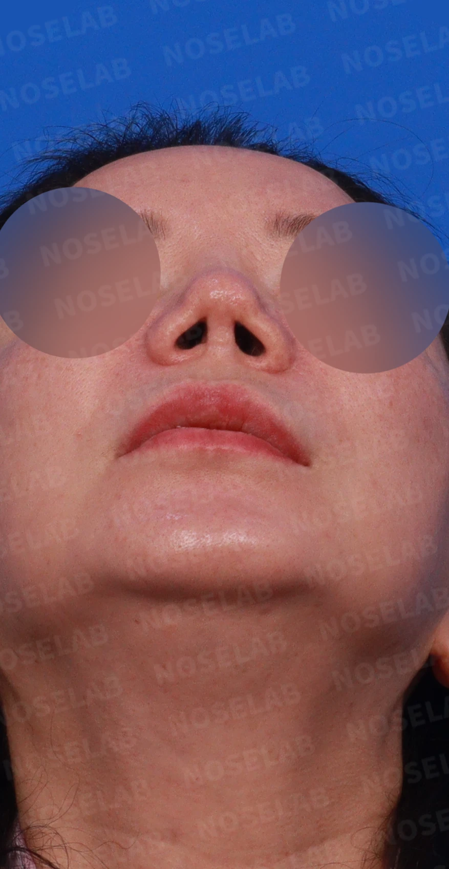 코끝이 찝히고 비주가 함몰되는 이유, 메드포어 제거와 재건은 어떻게 하나 — 디자인 상담 우측 비스듬한 측면, 측면, 비공 사진
