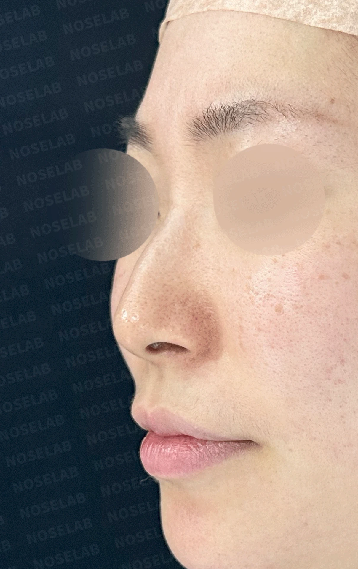 매부리코와 휜 코에 코막힘이 함께 오는 이유, 복합 교정은 어떻게 하나 — 본문 사진 11