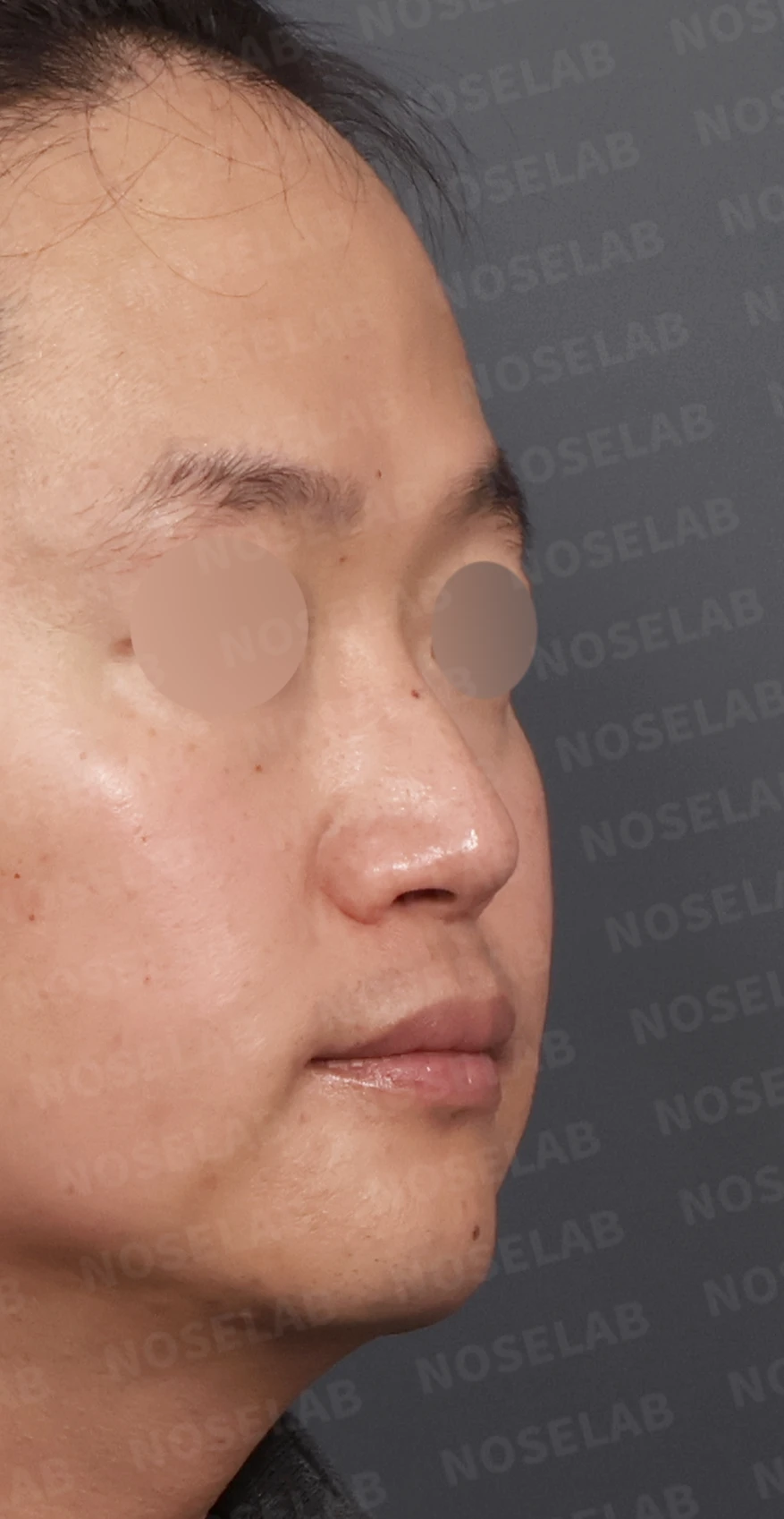 코막힘과 휘어진 비중격, 자가늑연골로 기능과 모양을 동시에 개선 — 디자인 상담 우측 측면, 비스듬한 측면, 비공 사진입니다.