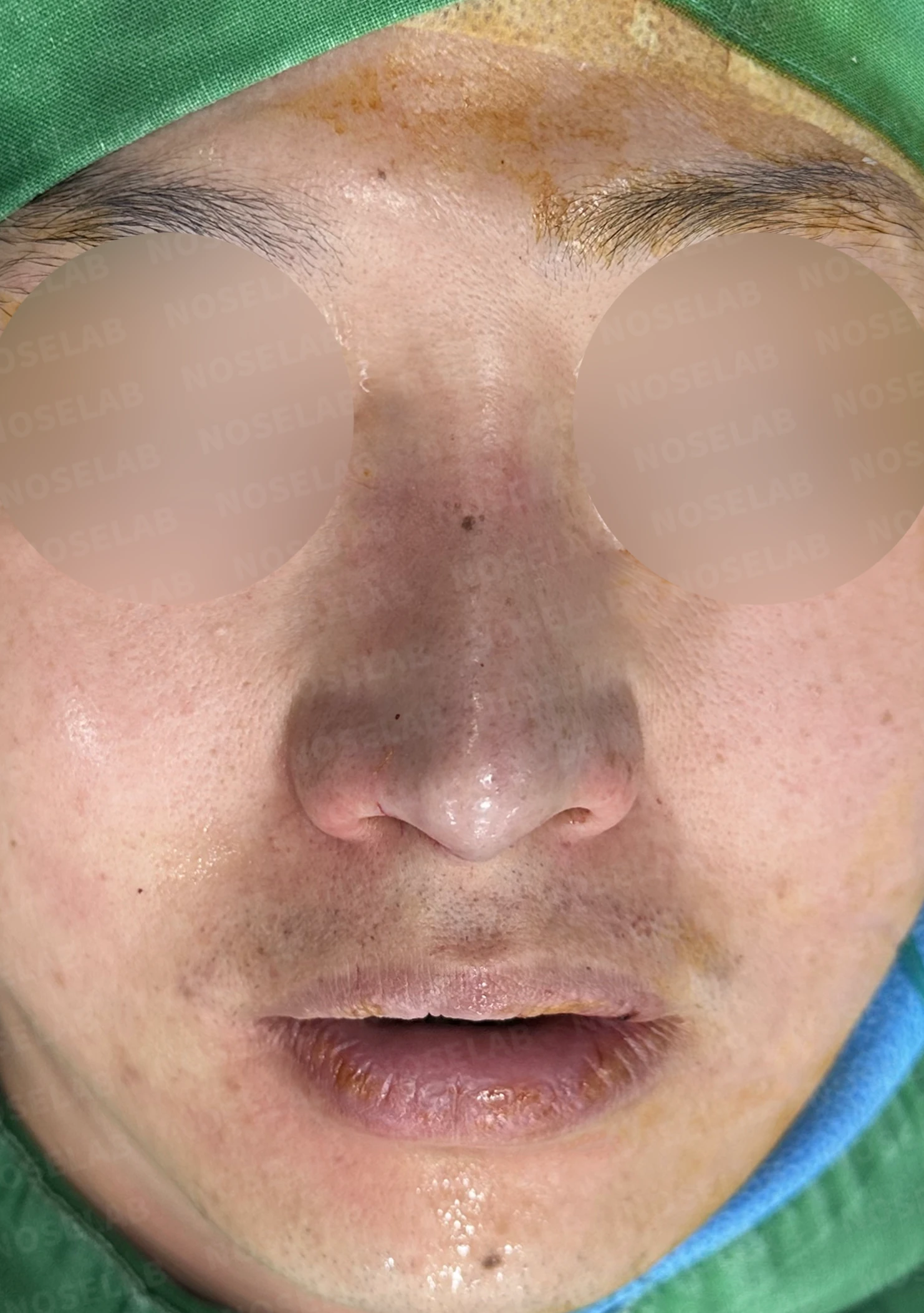 코막힘과 휘어진 비중격, 자가늑연골로 기능과 모양을 동시에 개선 — 전(좌) 직후(후)