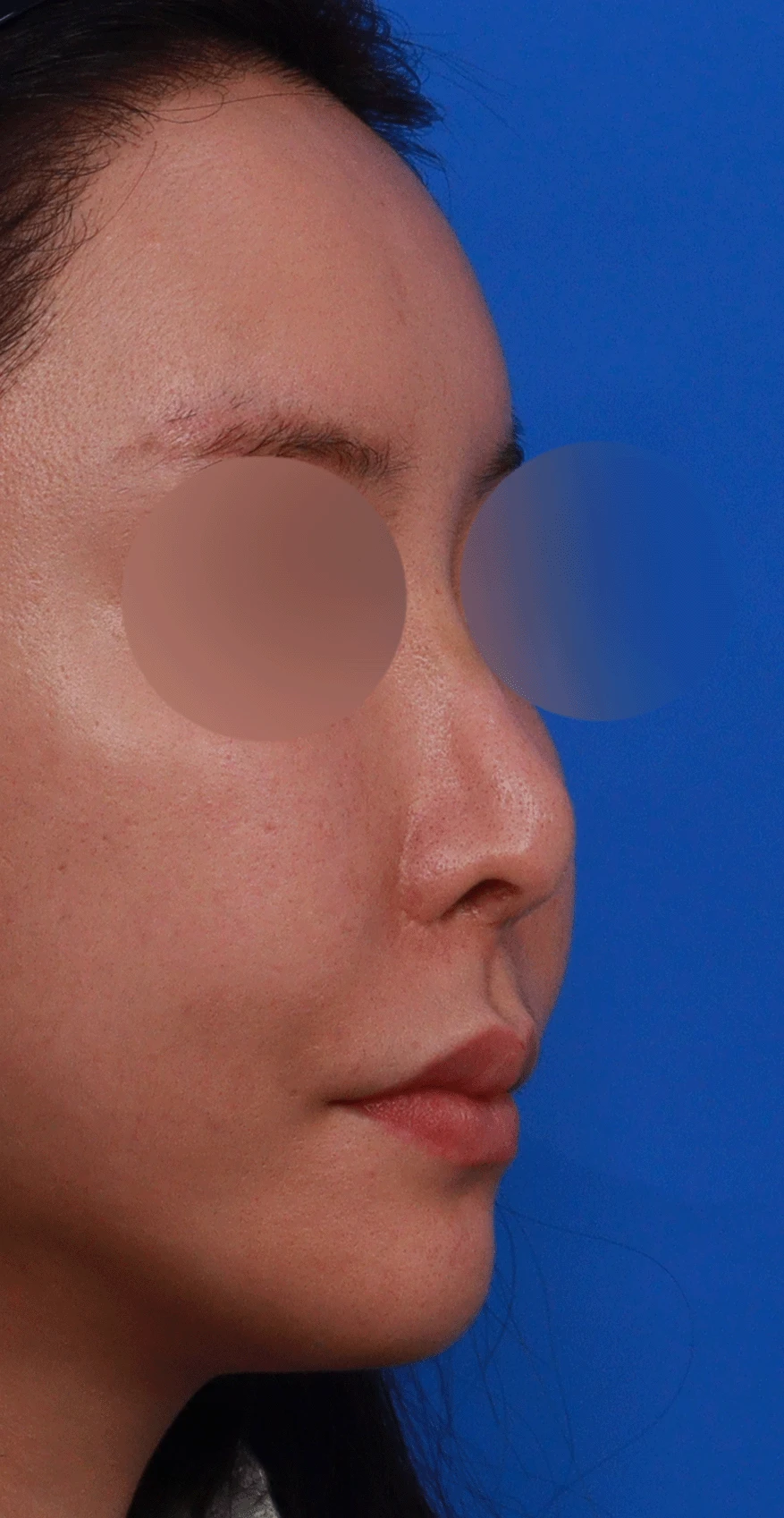 인공진피 이식 후 코끝이 비쳐 보이는 이유와 자가 늑연골 재건 방법 — 디자인 상담 우측 측면 , 비스듬한 측면 , 비공 사진입니다.