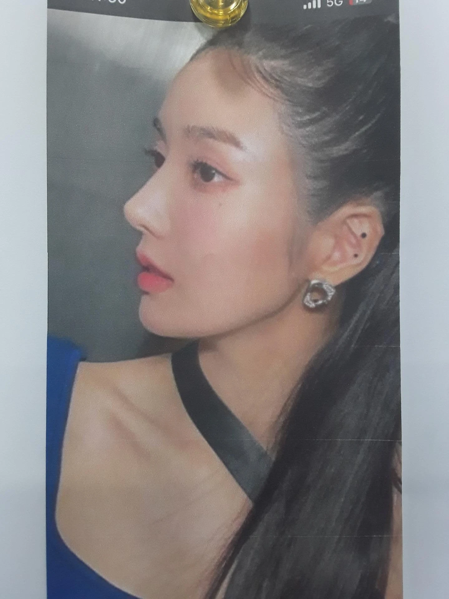 휘어진 코 교정과 비염 개선 - 자가늑연골 재건술 후기 — 환자분 원하는 이미지 사진들입니다.