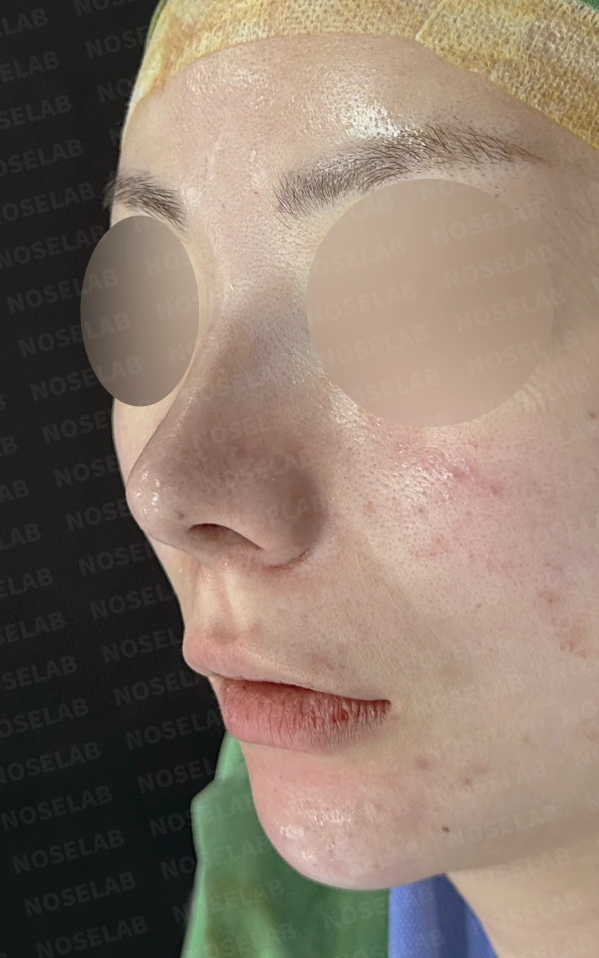 코끝이 퍼져 보이는 이유와 코바닥·비순각을 함께 다루는 방법 — 수술 직후 0일 정면, 비스듬한 측면, 측면 사진입니다. 직후 사진은 부기가 있는 상태로 최종 결과와 다를 수 있습니다.
