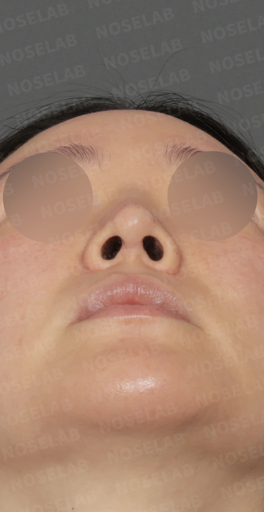 길고 처진 코 교정, 자가늑연골 비중격 재건과 콧대 보형물 교체로 완성한 코재수술 — 디자인 상담 우측 측면 , 비스듬한 측면 , 비공 사진 입니다.