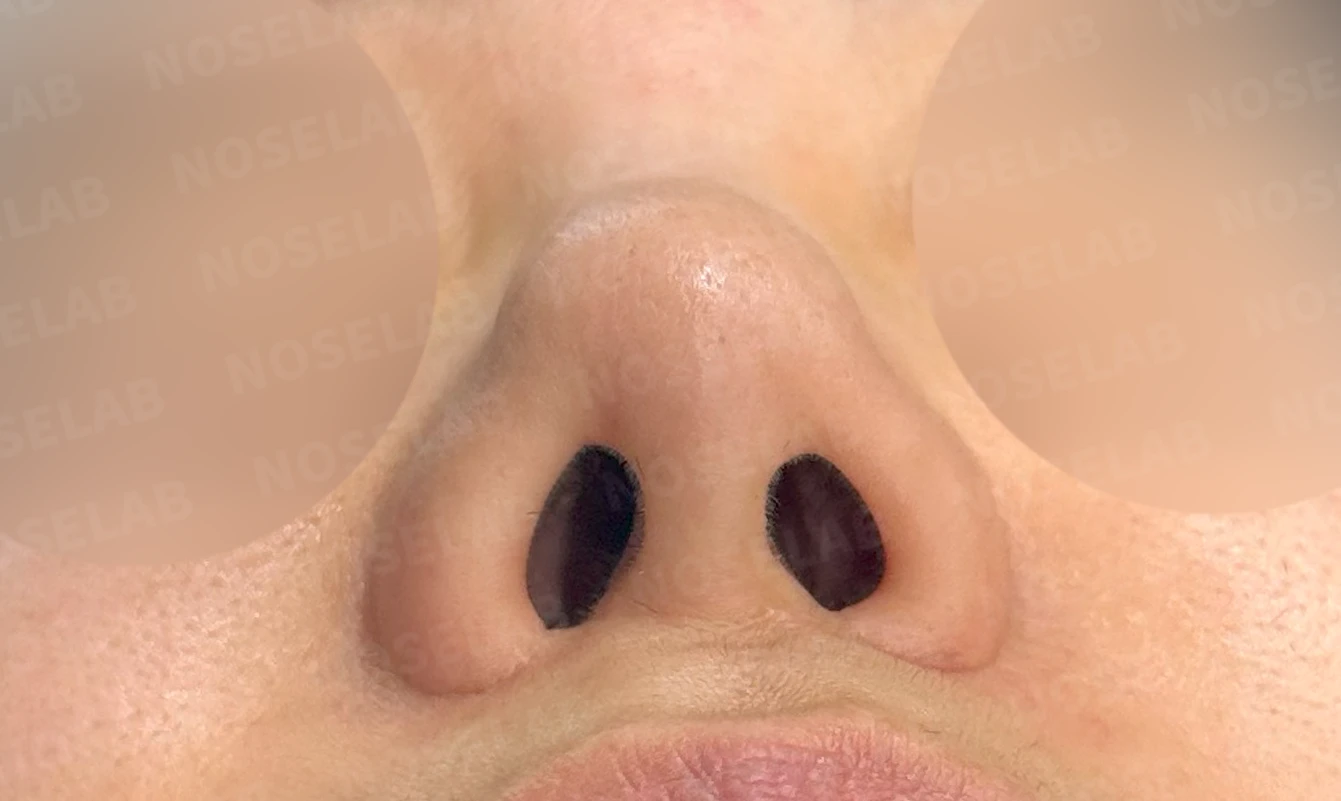보형물을 제거한 뒤 콧대가 꺼지고 퍼지는 이유, 재건은 어떻게 하나 — 수술 전 / 수술 직후 0일 직후 사진은 부기가 있는 상태로 최종 결과와 다를 수 있습니다.
