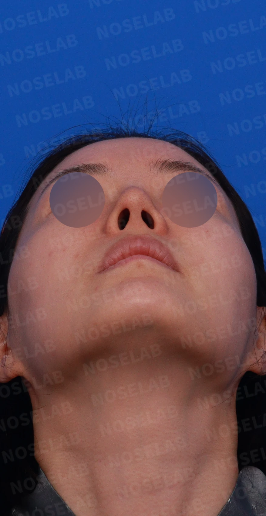 코끝이 비치는 이유와 코끝 포인트를 낮추는 교정 방법 — 디자인 상담 우측 측면,비스듬한 측면, 비공 사진입니다.