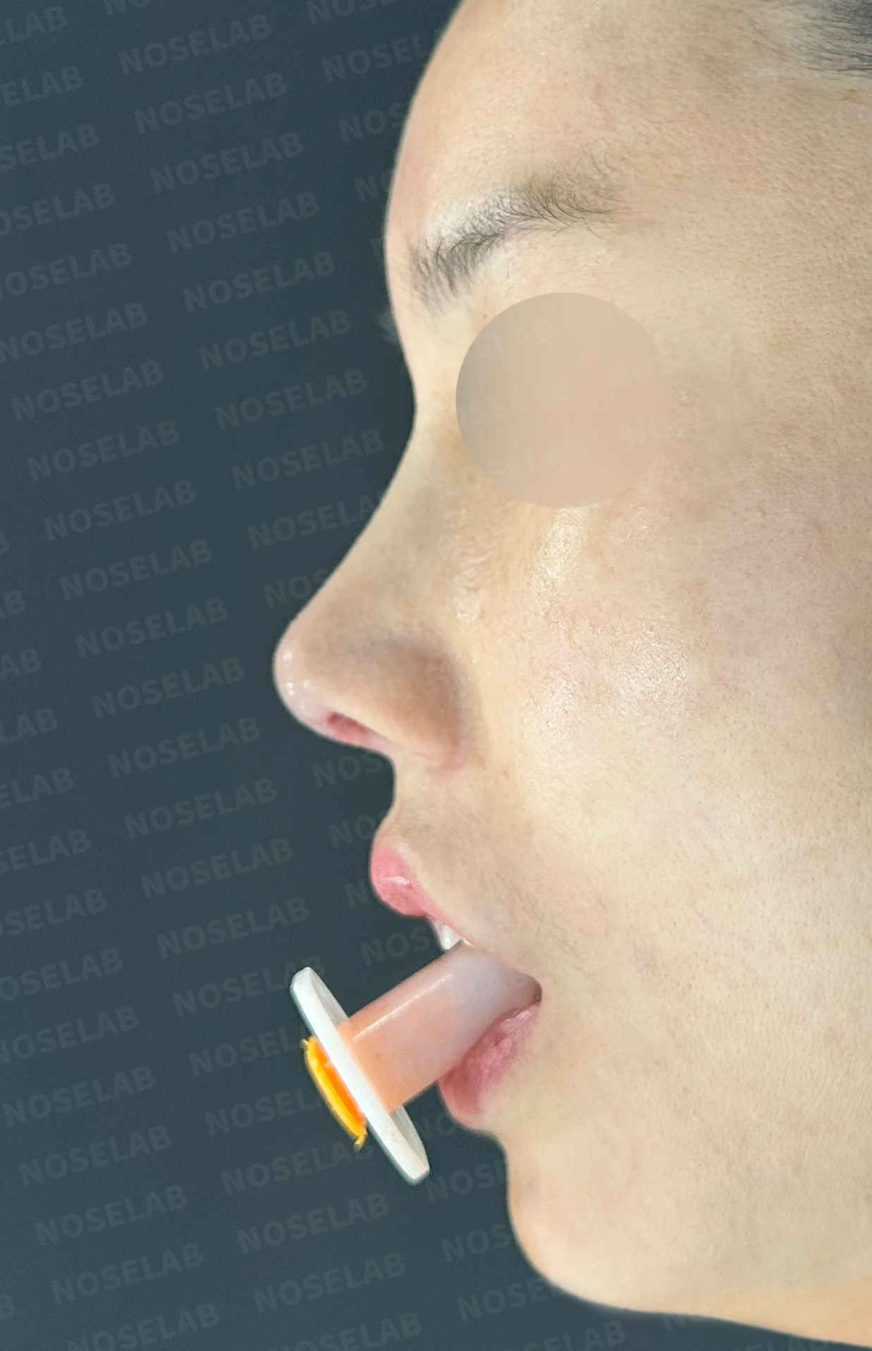 메드포어를 넣은 코에 코막힘이 생기는 이유, 제거와 자가늑연골 비중격 재건은 어떻게 하나 — 수술 전 / 수술 직후 0일 직후 사진은 부기가 있는 상태로 최종 결과와 다를 수 있습니다.