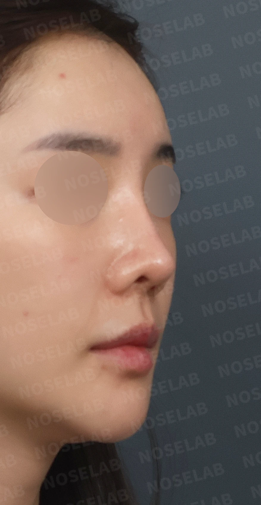 휘어진 코와 퍼진 코끝, 자가늑연골로 세련된 직반라인 완성한 코재수술 — 디자인 상담 우측 측면, 비스듬한 측면, 비공 사진입니다.