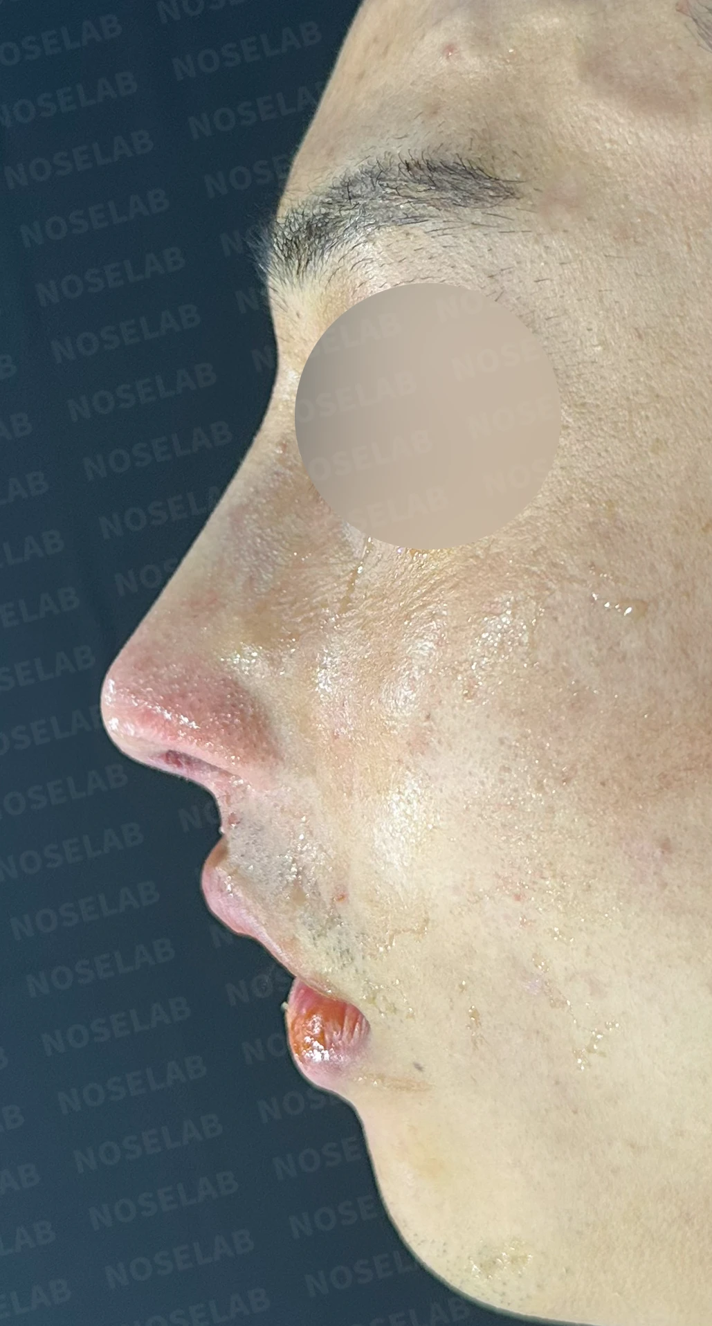 비염 수술 뒤에도 증상이 재발하는 이유, 휜 코를 함께 교정하는 방법 — 수술 직후 0일 정면, 측면, 비스듬한 측면 사진 직후 사진은 부기가 있는 상태로 최종 결과와 다를 수 있습니다.