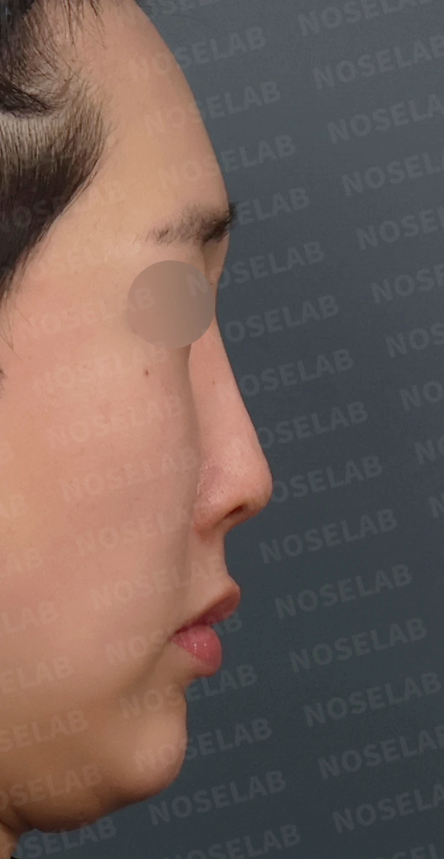 실리콘이 휘고 코가 길어 보이는 이유, 보형물 교체와 늑연골 재건은 어떻게 하나 — 디자인 상담 우측 측면, 비스듬한 측면, 비공 사진입니다.
