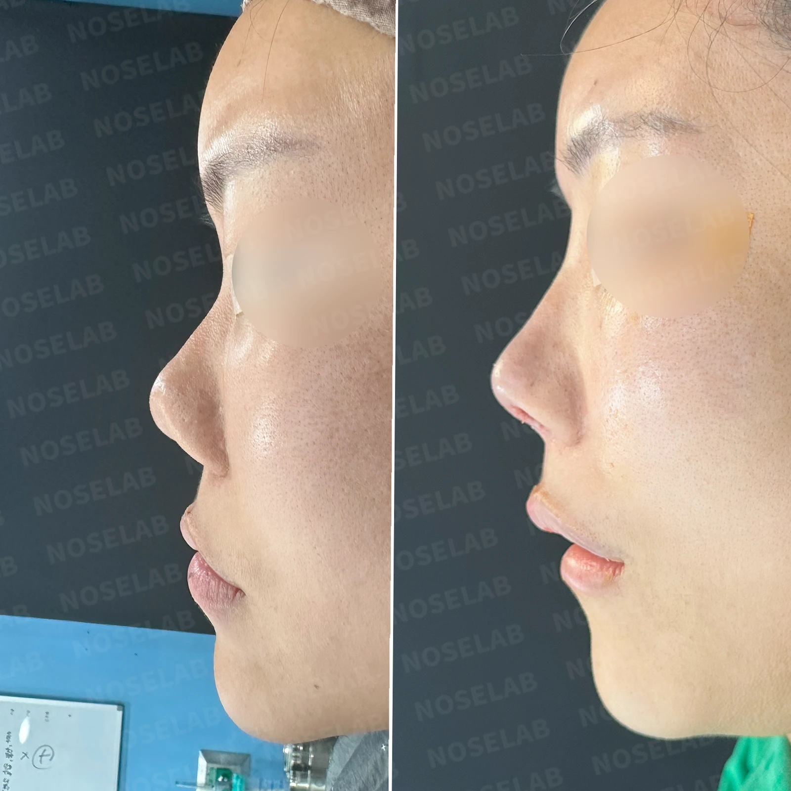 코성형 뒤 감염이 반복되는 이유, 염증 치료와 단계적 재건은 어떻게 하나 — 본문 사진 20