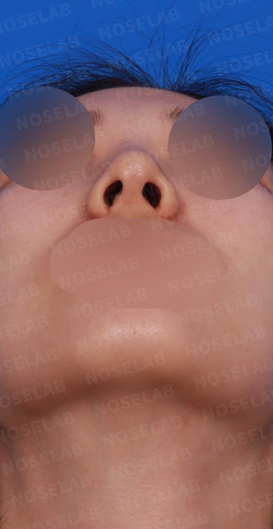 매부리를 정리한 뒤 콧등이 눌려 보이고 코끝이 뭉툭해지는 이유, 보형물 없이 교정하는 방법 — 디자인 상담 우측 측면, 비스듬한 측면, 비공 사진