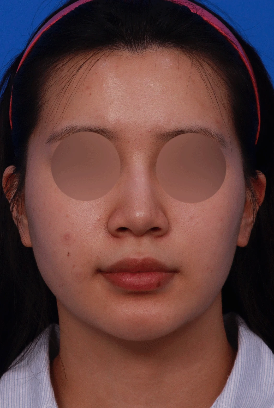 복코가 잘 교정되지 않는 이유와 이물질 제거 후 재건 방법 — 디자인 상담 정면 , 좌측 측면 ,비스듬한 측면 사진