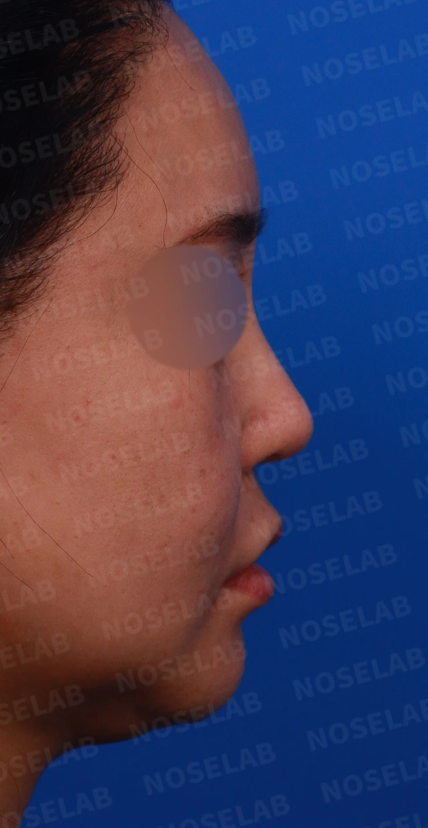 코재수술에서 비중격을 재건하는 방법 — 디자인 상담 비공, 우측 측면, 비스듬한 측면 사진