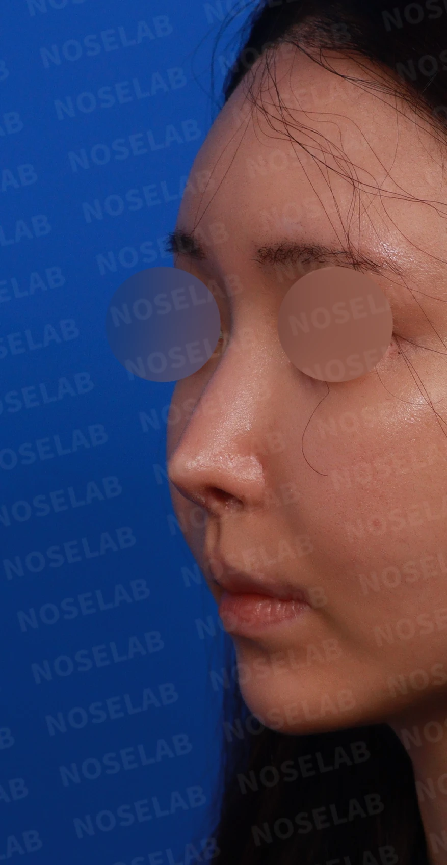 뾰족한 코끝과 연골 비침의 교정 방법 — 디자인 상담 정면, 좌측 측면, 비스듬한 측면 사진입니다.
