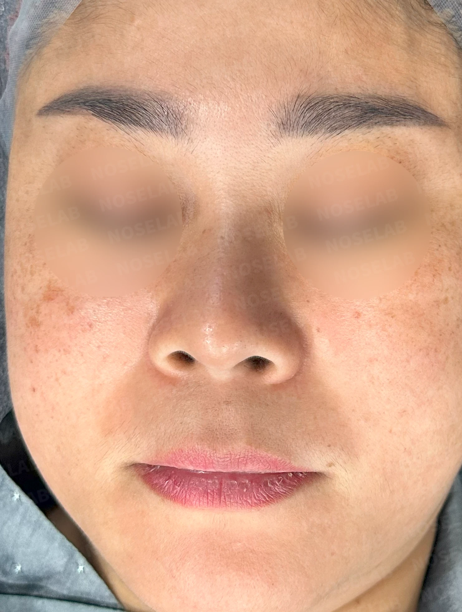 짧은 코와 코막힘을 함께 교정하는 방법 — 수술 전 / 수술 직후 0일 직후 사진은 부기가 있는 상태로 최종 결과와 다를 수 있습니다.