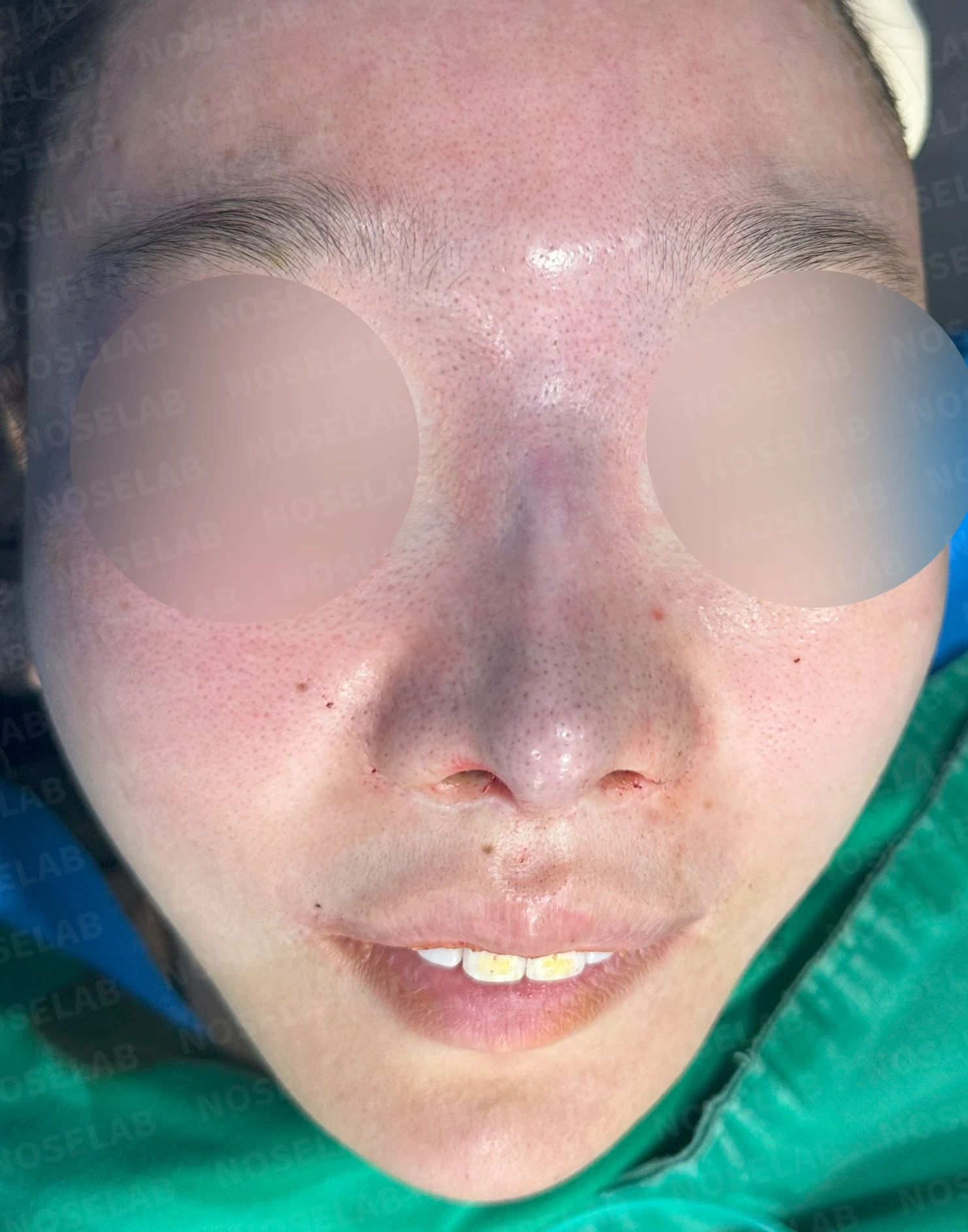 콧대가 뭉툭하게 퍼져 보이는 만성 이물 반응, 원인과 재건 방법 — 수술 직후 0일 정면, 측면, 비스듬한 측면 사진 직후 사진은 부기가 있는 상태로 최종 결과와 다를 수 있습니다.