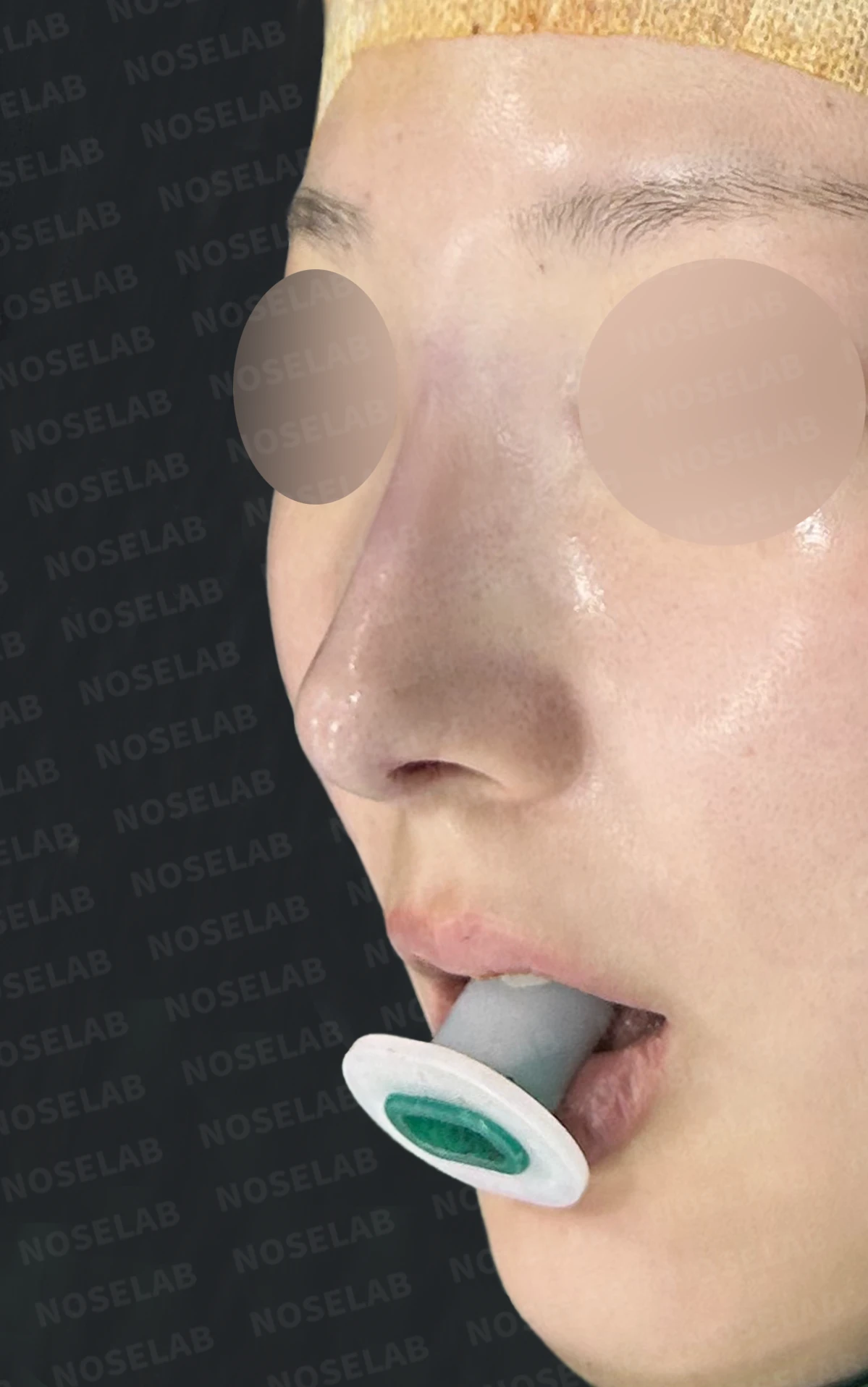 코재수술, 휘어진 코뼈와 매부리코를 외측 절골술과 자가늑연골로 자연스럽게 교정 — 수술직후 정면, 비스듬한 측면, 측면 사진입니다.