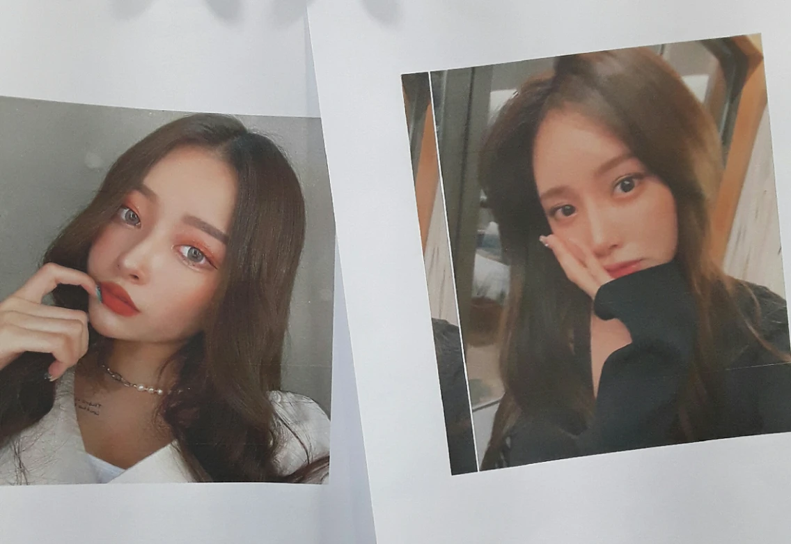 두꺼운 비주와 들린 코끝이 생기는 이유, 자가 늑연골 재건은 어떻게 하나 — 본문 사진 1