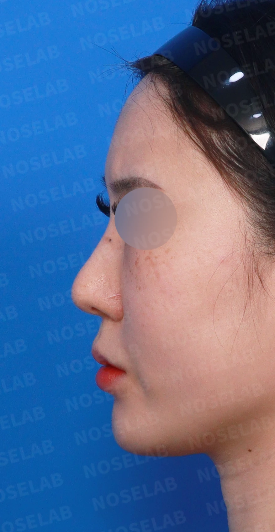 길고 뭉툭한 코, 자가늑연골로 화려하면서 자연스럽게 — 디자인 상담 정면, 좌측 측면, 비스듬한 측면 사진입니다.