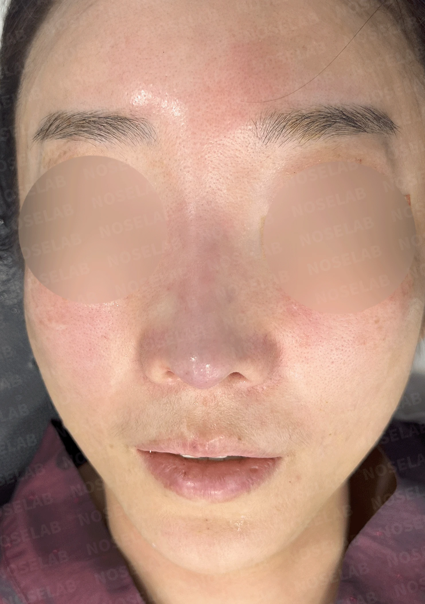 반복된 코재수술 뒤 안장코와 비밸브 협착이 생기는 이유, 전체 재건은 어떻게 하나 — 수술 직후 0일 정면 , 측면 , 비스듬한 측면 사진입니다. 직후 사진은 부기가 있는 상태로 최종 결과와 다를 수 있습니다.