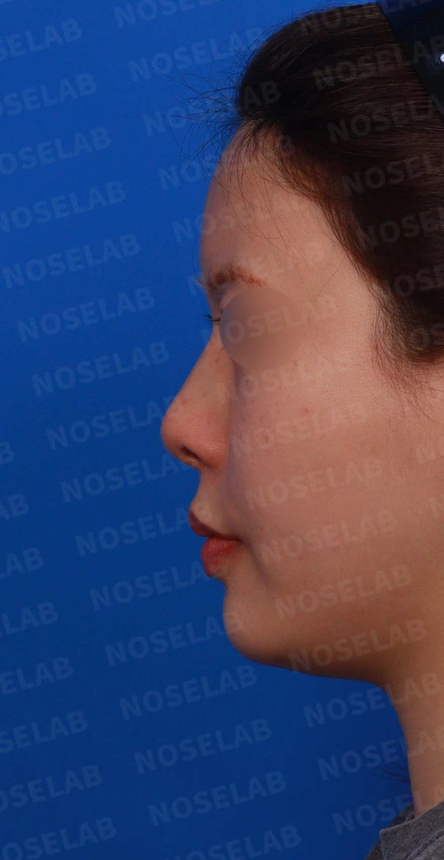 고개를 들면 콧구멍 모양이 다르고 코가 막히는 이유, 비중격 재건 방법 — 디자인 상담 정면 , 좌측 측면 , 비스듬한 측면 사진입니다.
