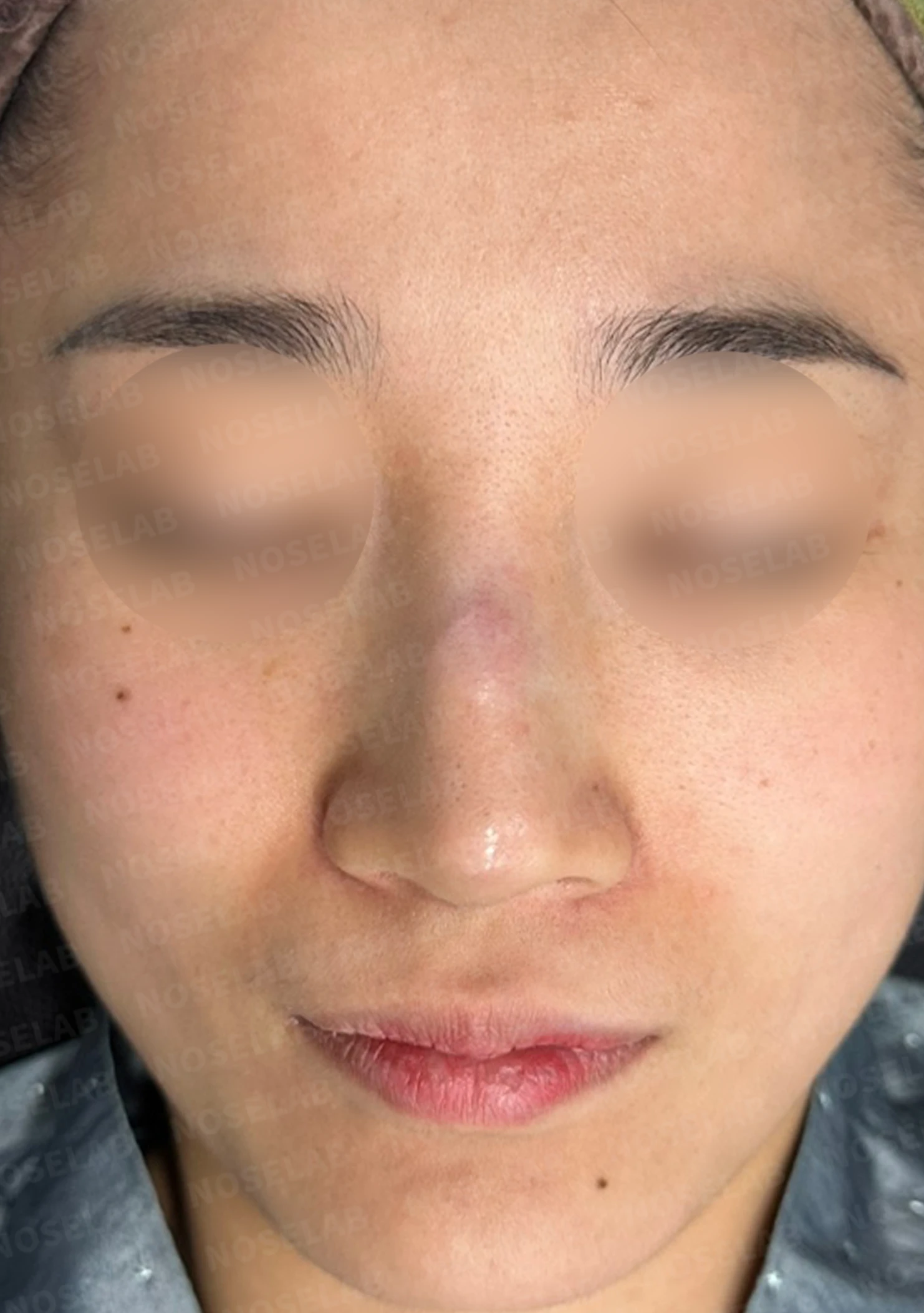 메드포어 점막 돌출로 인한 염증 코 - 자가늑연골 재건 수술 후기 — 전(좌) 직후(우)