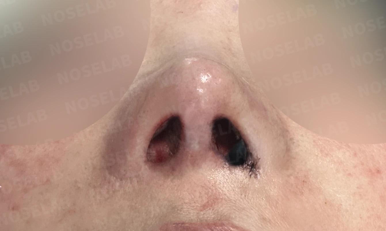 코성형 뒤 코막힘이 더 심해지는 이유, 비중격 재건과 절골 복원은 어떻게 하나 — 수술 직후 0일 비공 사진입니다. 직후 사진은 부기가 있는 상태로 최종 결과와 다를 수 있습니다.