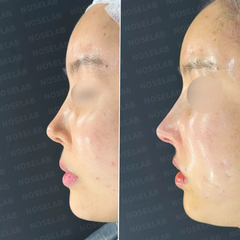 코가 들리고 콧기둥이 꺼지며 코끝이 찝혀 보이는 이유, 복합 교정은 어떻게 하나 — 전후 비교