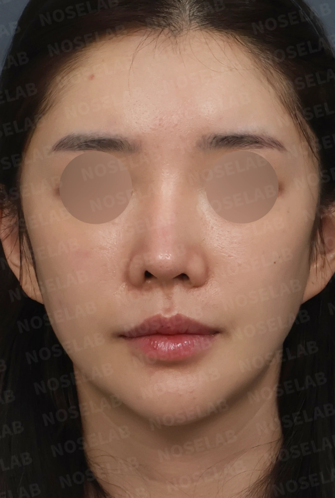 휘어진 코와 퍼진 코끝, 자가늑연골로 세련된 직반라인 완성한 코재수술 — 디자인 상담 정면, 좌측 측면, 비스듬한 측면 사진입니다.