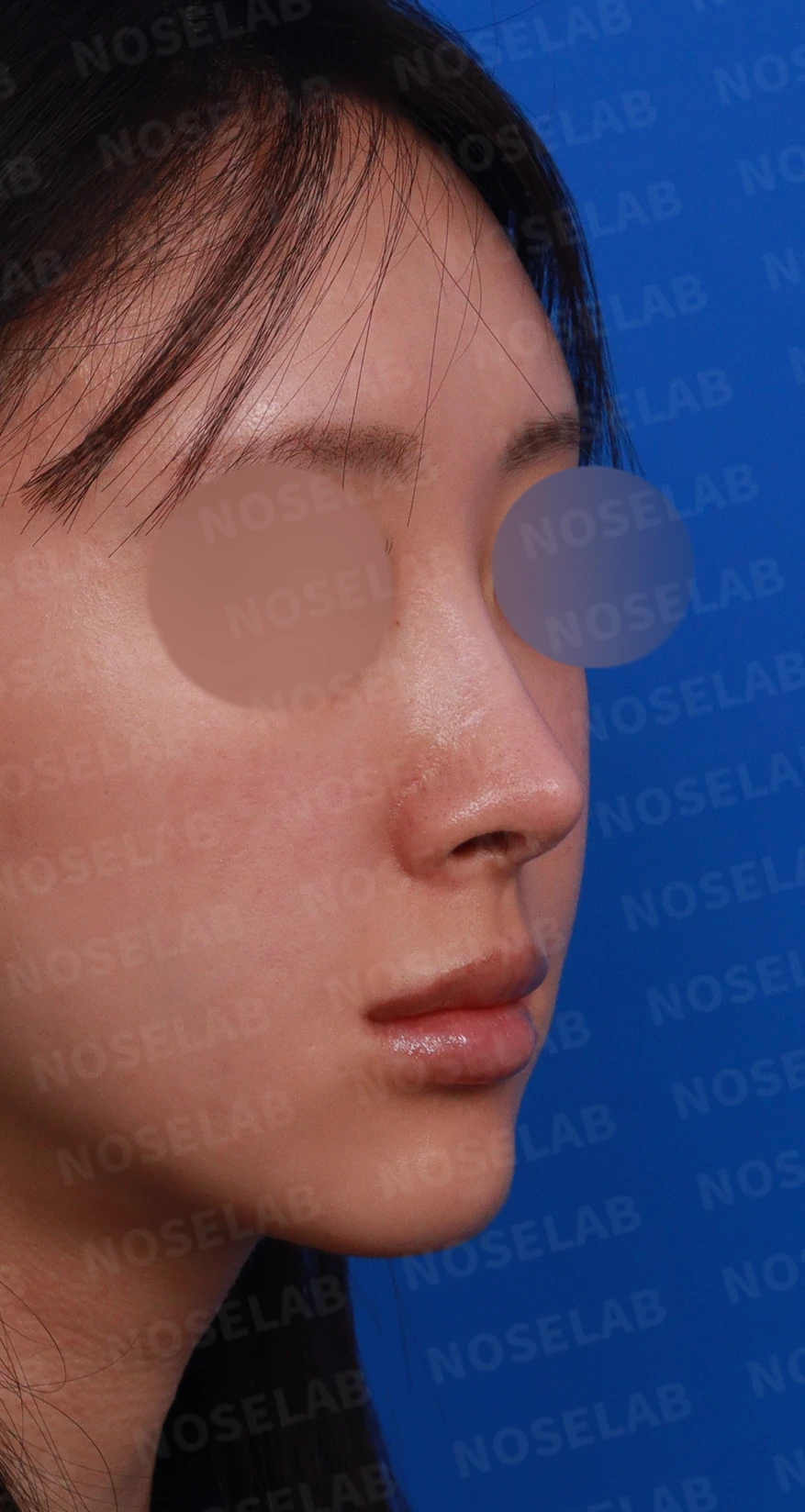 뾰족한 코끝과 연골 비침 - 자가진피 코 재수술 후기 — 디자인 상담 우측 측면, 비스듬한 측면, 비공 사진