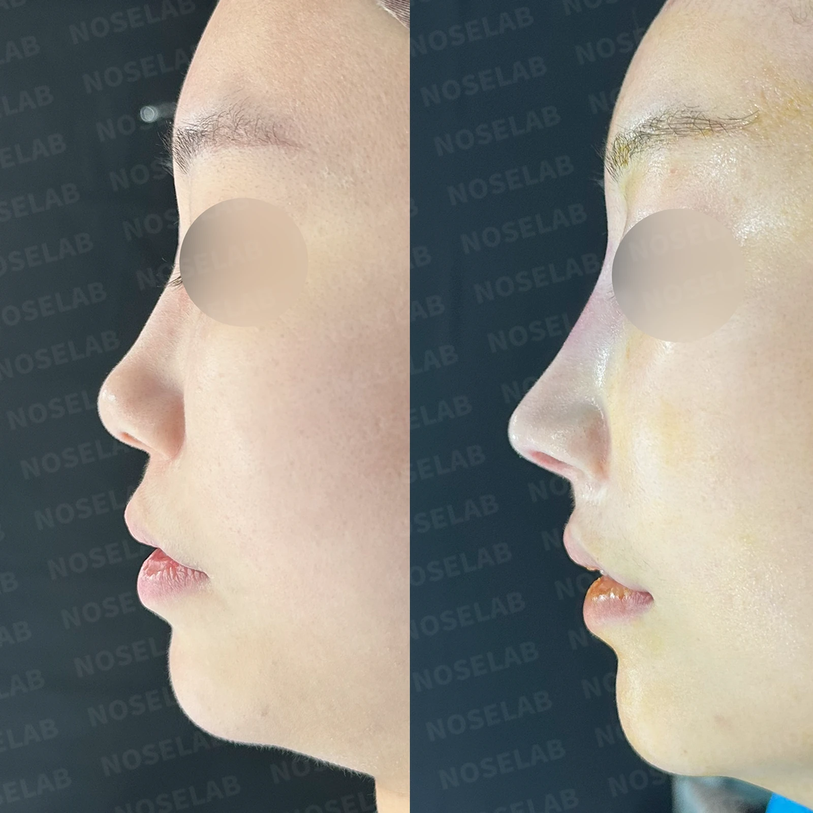 필러와 실이 남아 있는 코, 제거 후 늑연골 재건은 어디까지 가능한가 — 본문 사진 20