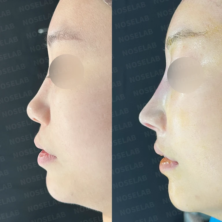 코필러 시술후 코성형 수술로 화려한 코 만들기 - 기증늑연골 실제 후기 — 전후 비교