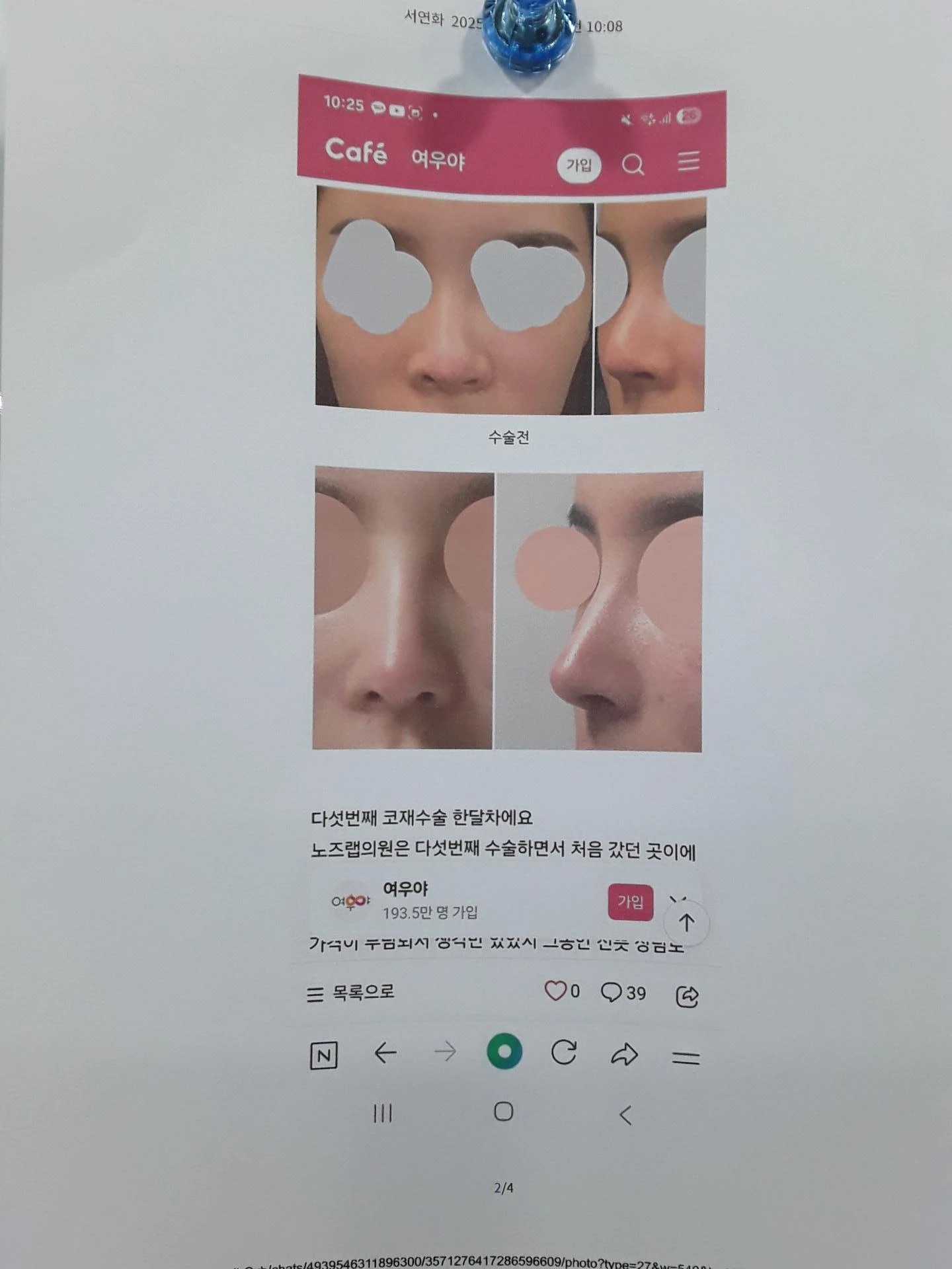 코 수술 뒤 염증이 오래 지속되면 생기는 변화와 재건 방법 — 환자분 요구사항 사진들