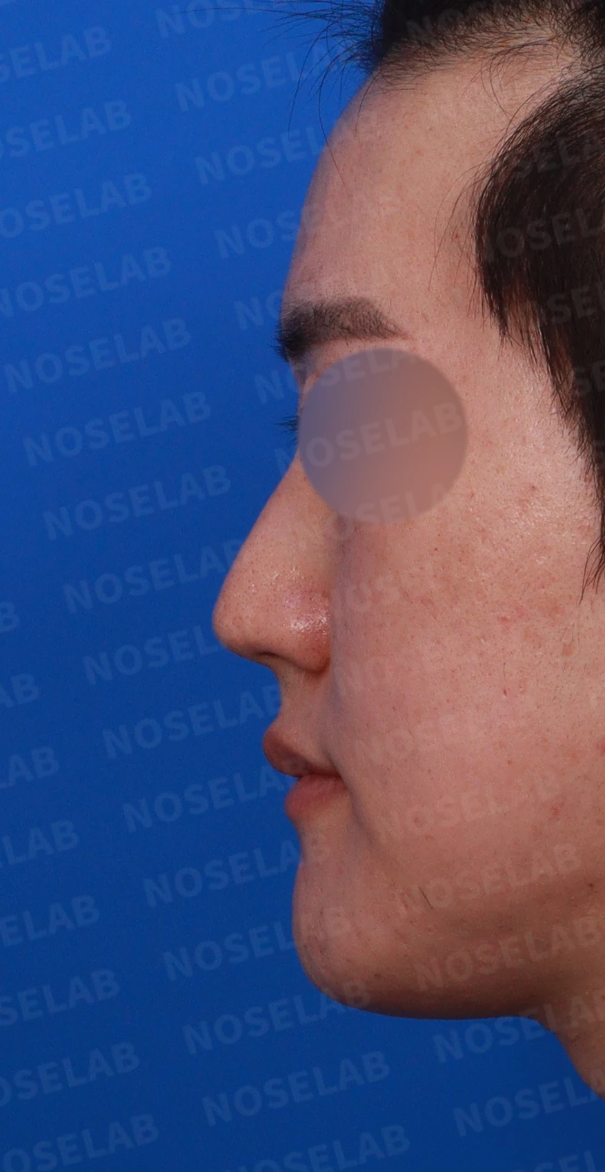 보형물 없이 코끝과 경계 부분만 교정하는 방법 — 디자인 상담 정면, 좌측 측면, 비스듬한 측면 사진